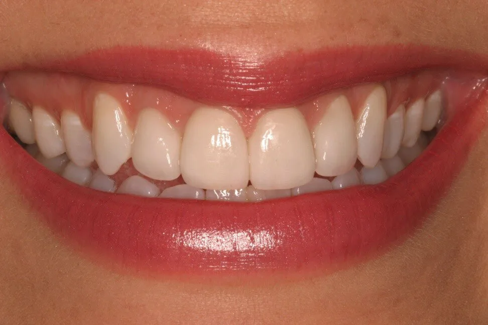 Patient 1 after treatment