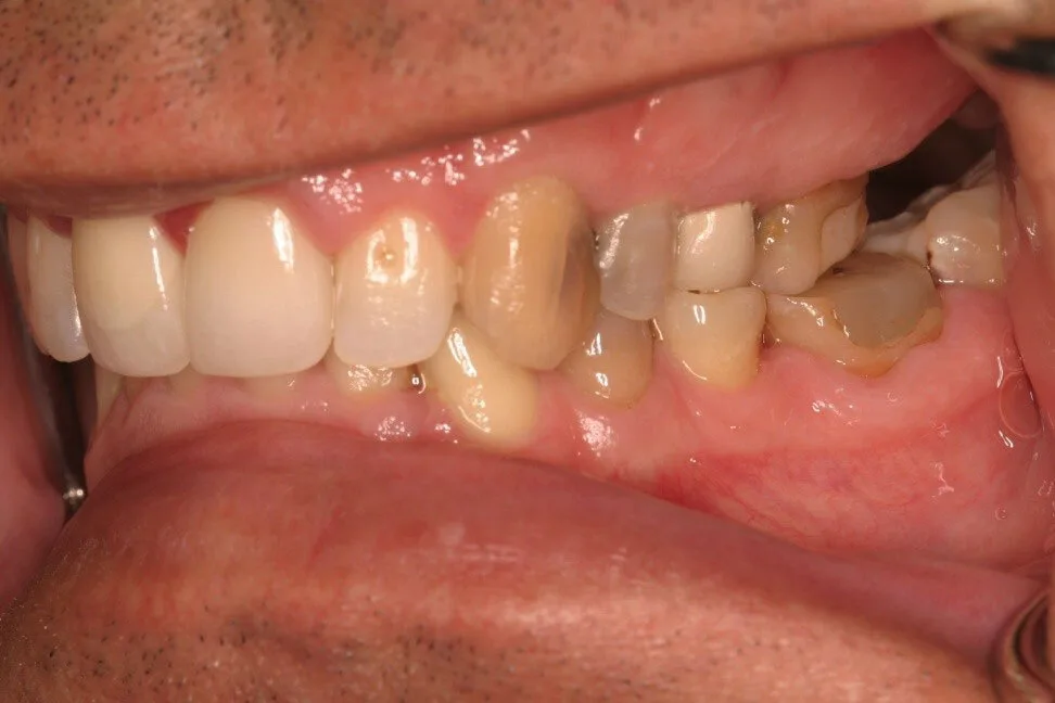 Patient 3 before treatment