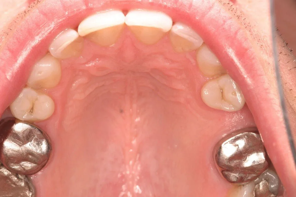Patient 4 before treatment