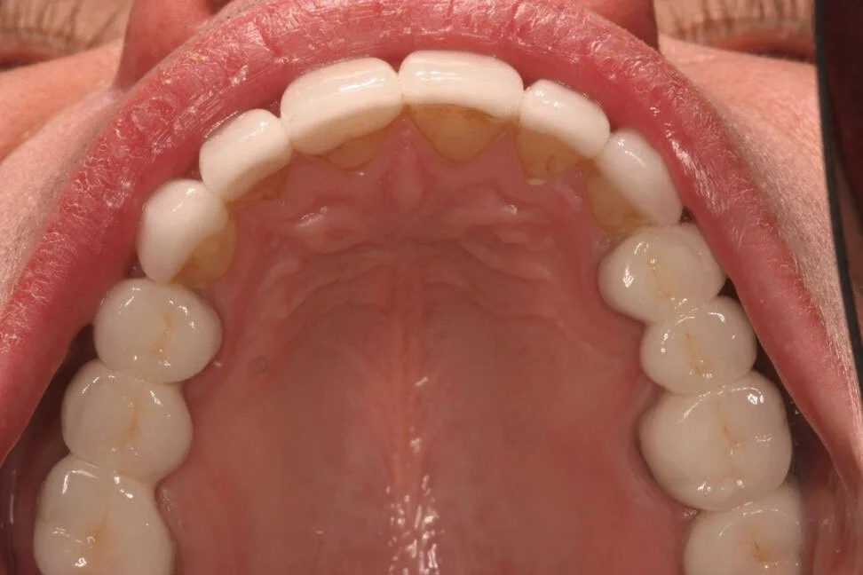 Patient 4 after treatment