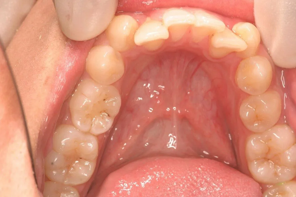 Patient 5 before treatment