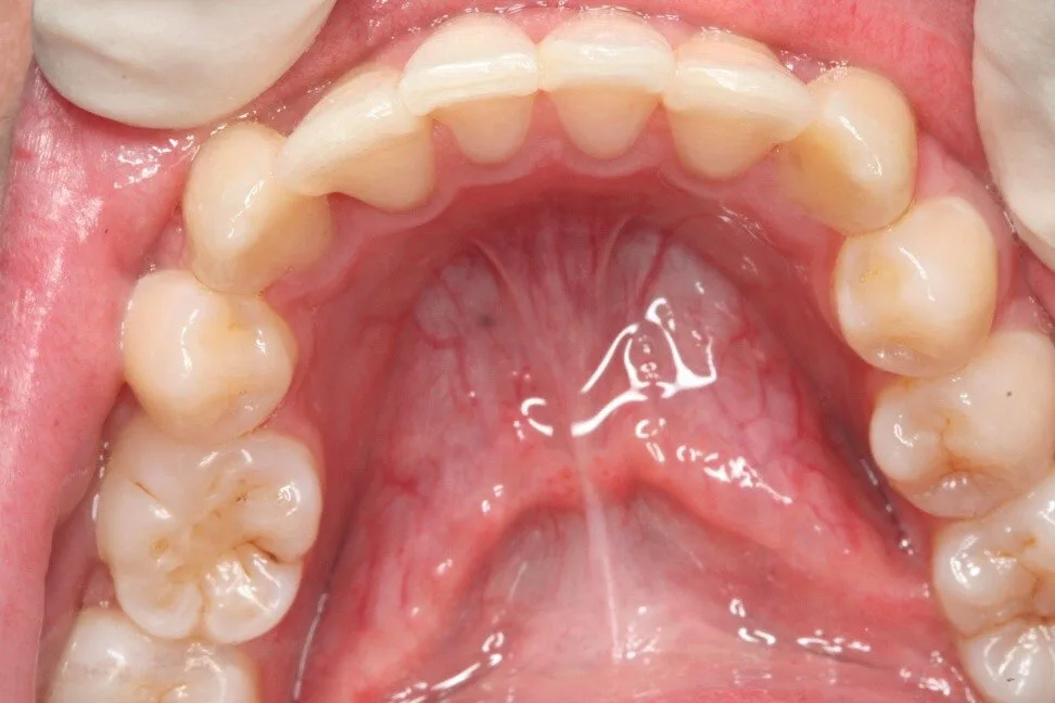 Patient 5 after treatment