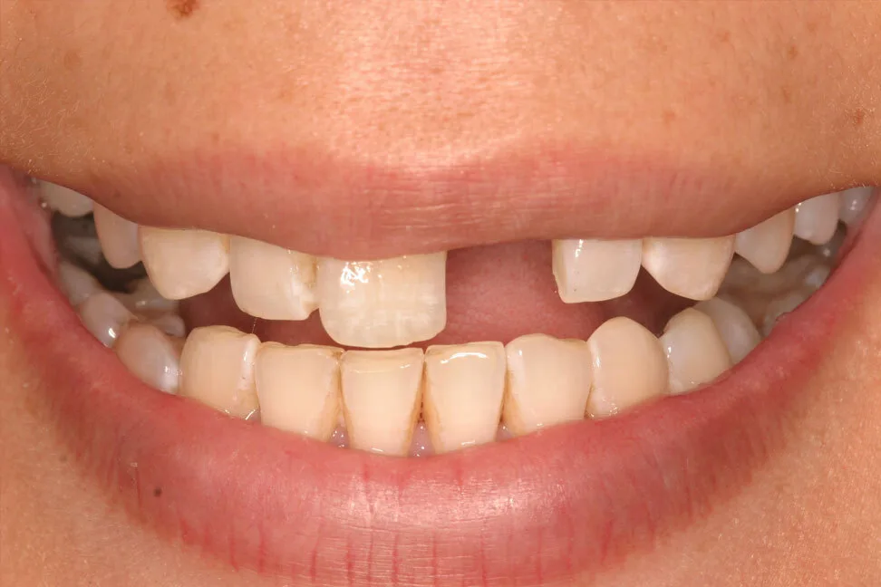 Patient 6 before treatment