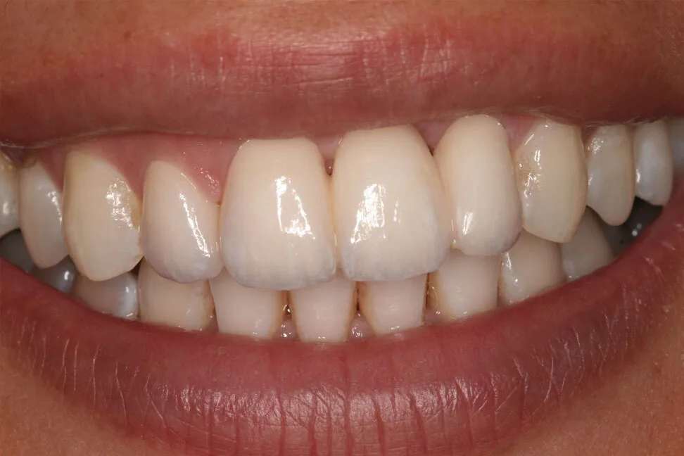 Patient 6 after treatment